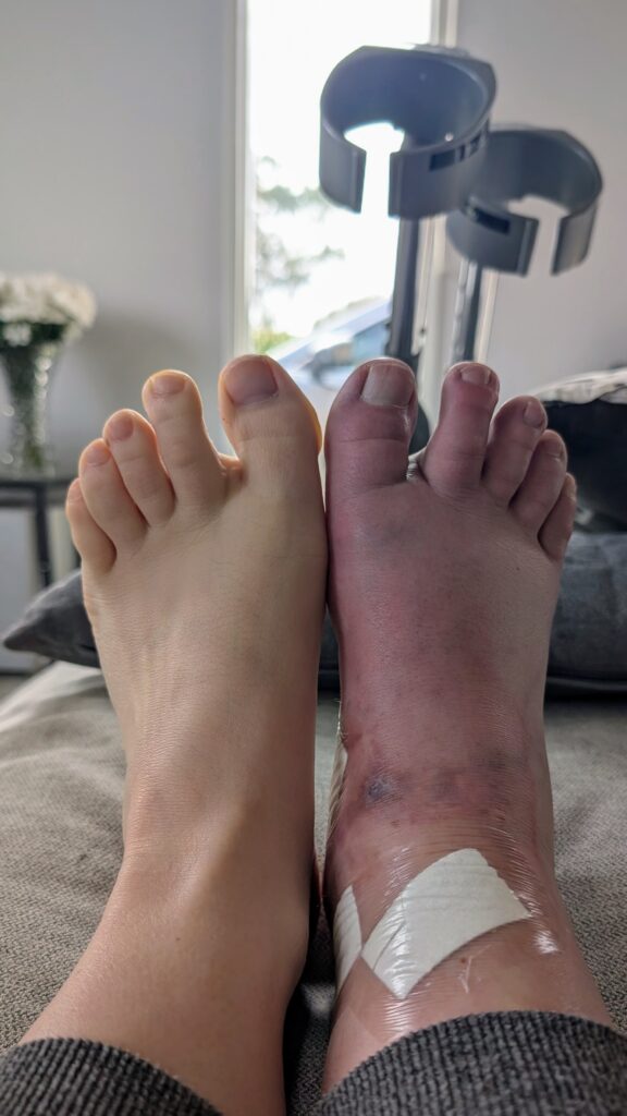 Photo of Lauren's feet while recovering from sclerotherapy on her extra veins. Her right foot is discoloured, bruised and scarred from previous procedures and has dressings covering new incisions.  A pair of crutches is visible in the background.